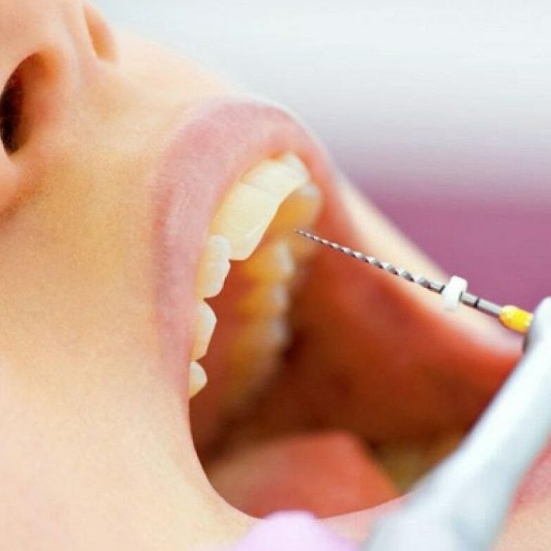 Endodoncia - NeoDonto