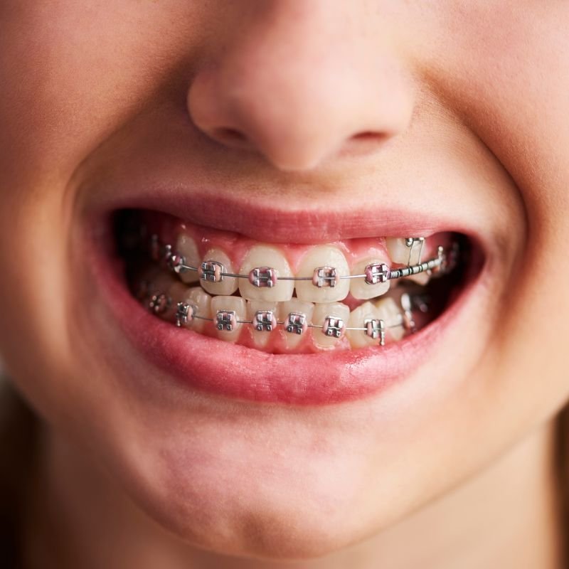 Ortodoncia - NeoDonto